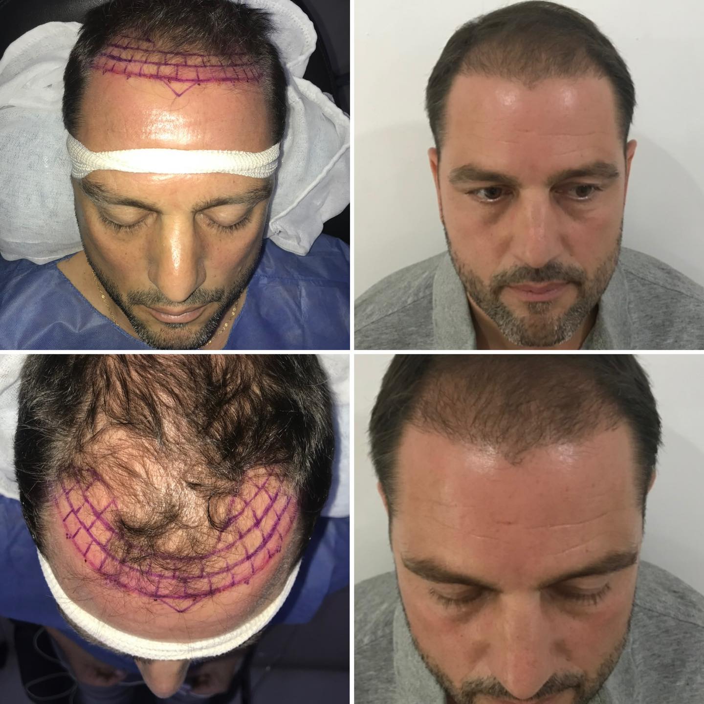 Trasplante capilar I Implantpel | Implantpel