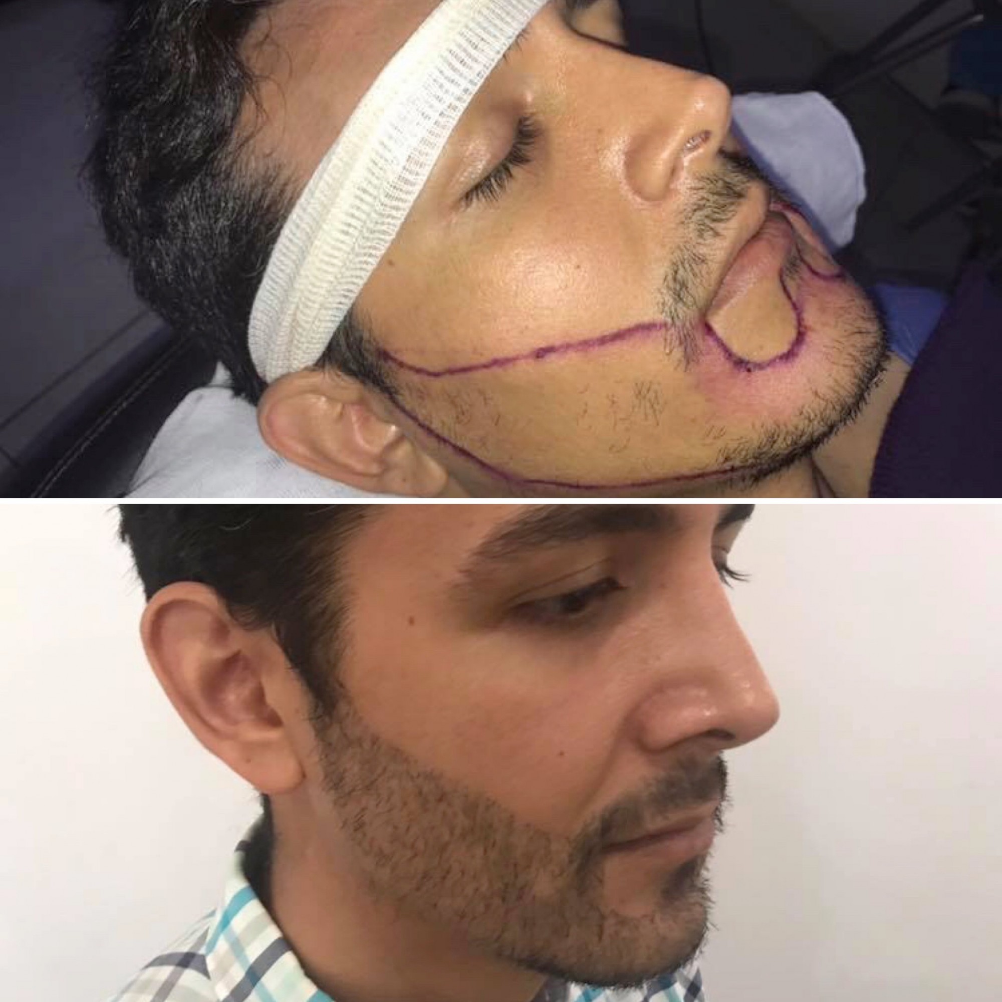 Trasplante capilar I Implantpel | Implantpel