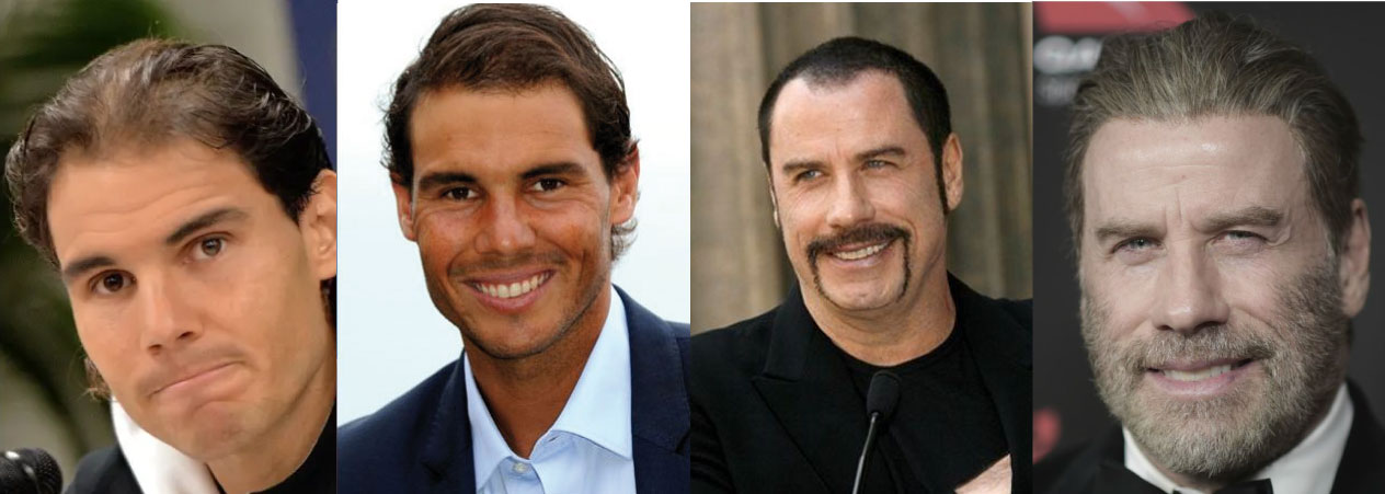 ¿Qué famosos se han realizado un Injerto Capilar? | Implantpel