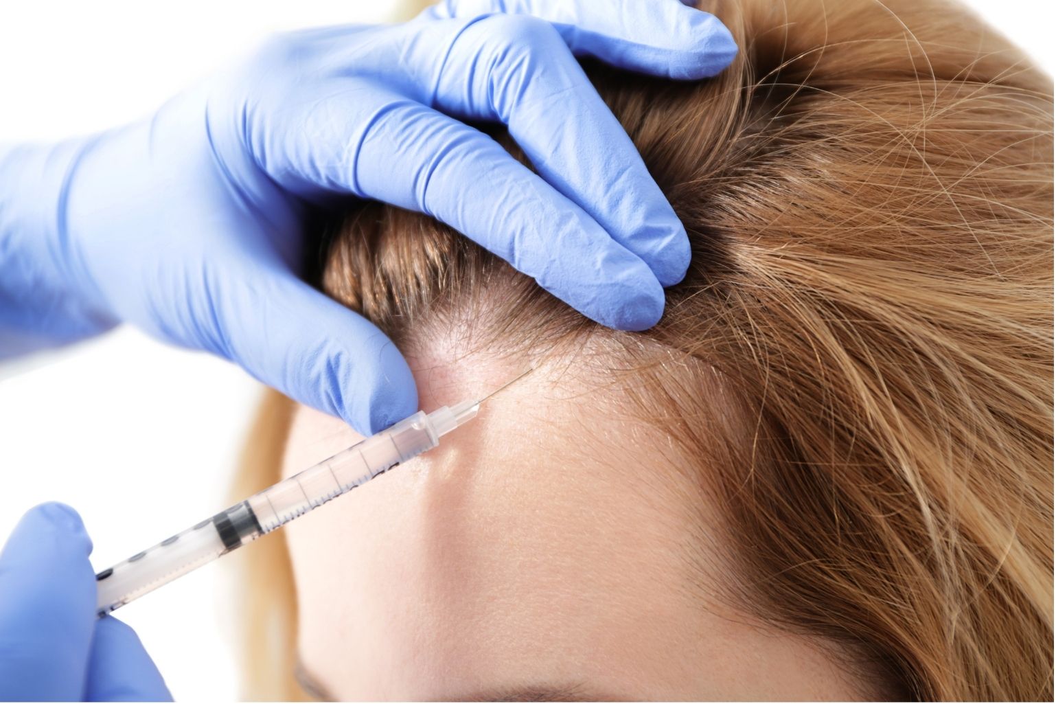 La Invisible Carga de la Alopecia Femenina | Implantpel