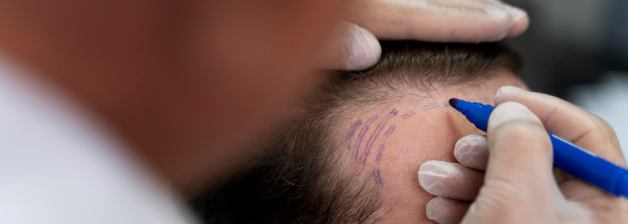 ¿Qué factores influyen en el costo de un trasplante capilar? | Implantpel