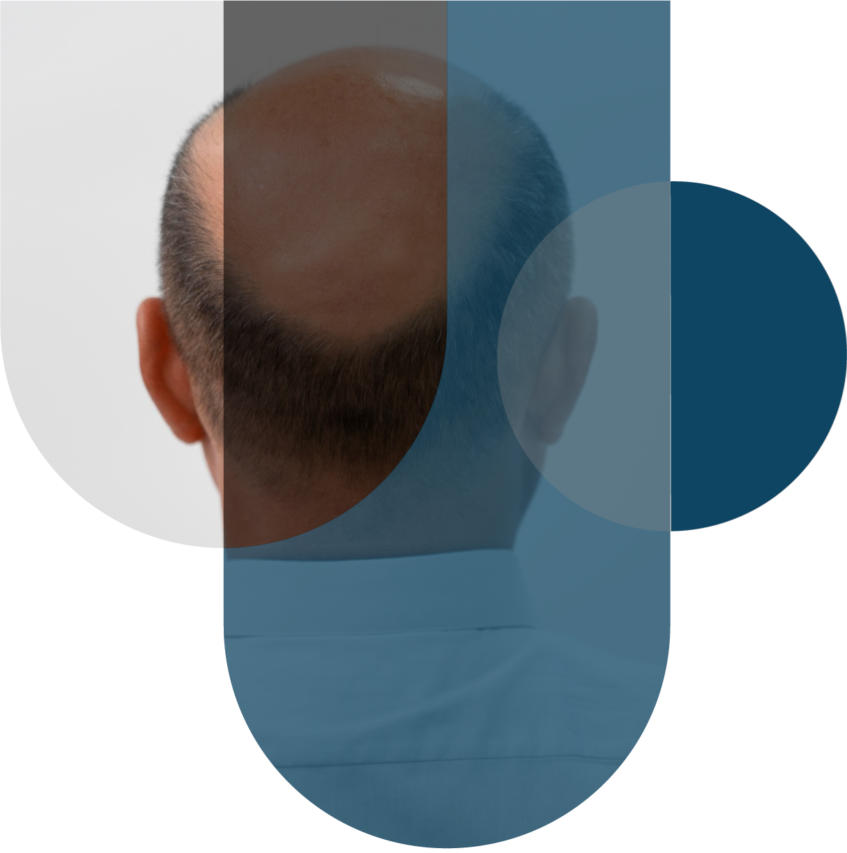 Alopecia