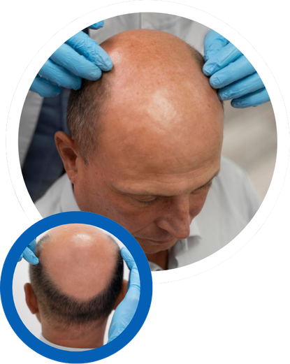 Alopecia