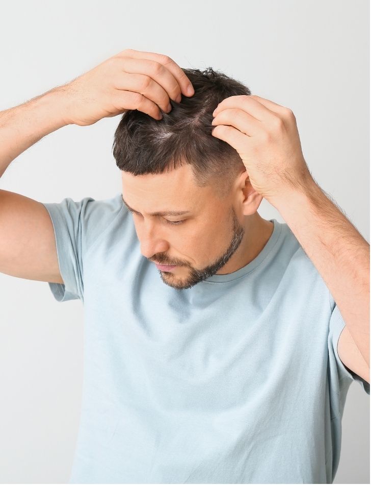 ¿Qué rol juega el estrés en la caída capilar? | Implantpel