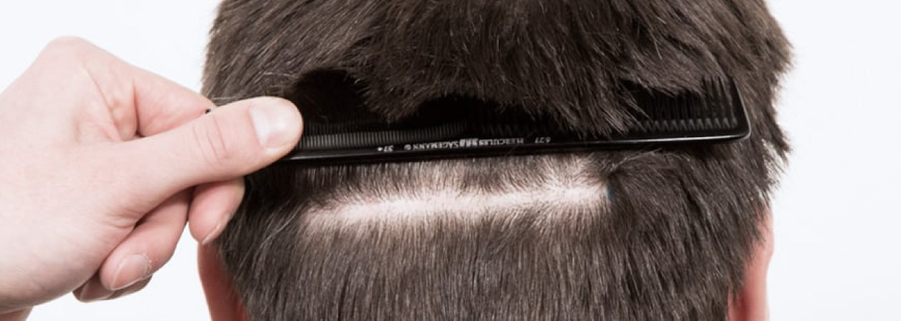 Conoce la Técnica FUT | Implantpel